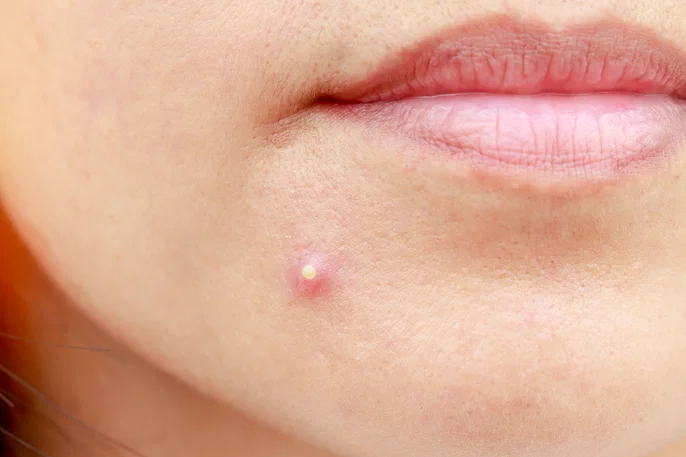 Tratamento de acne adulta em Indaiatuba